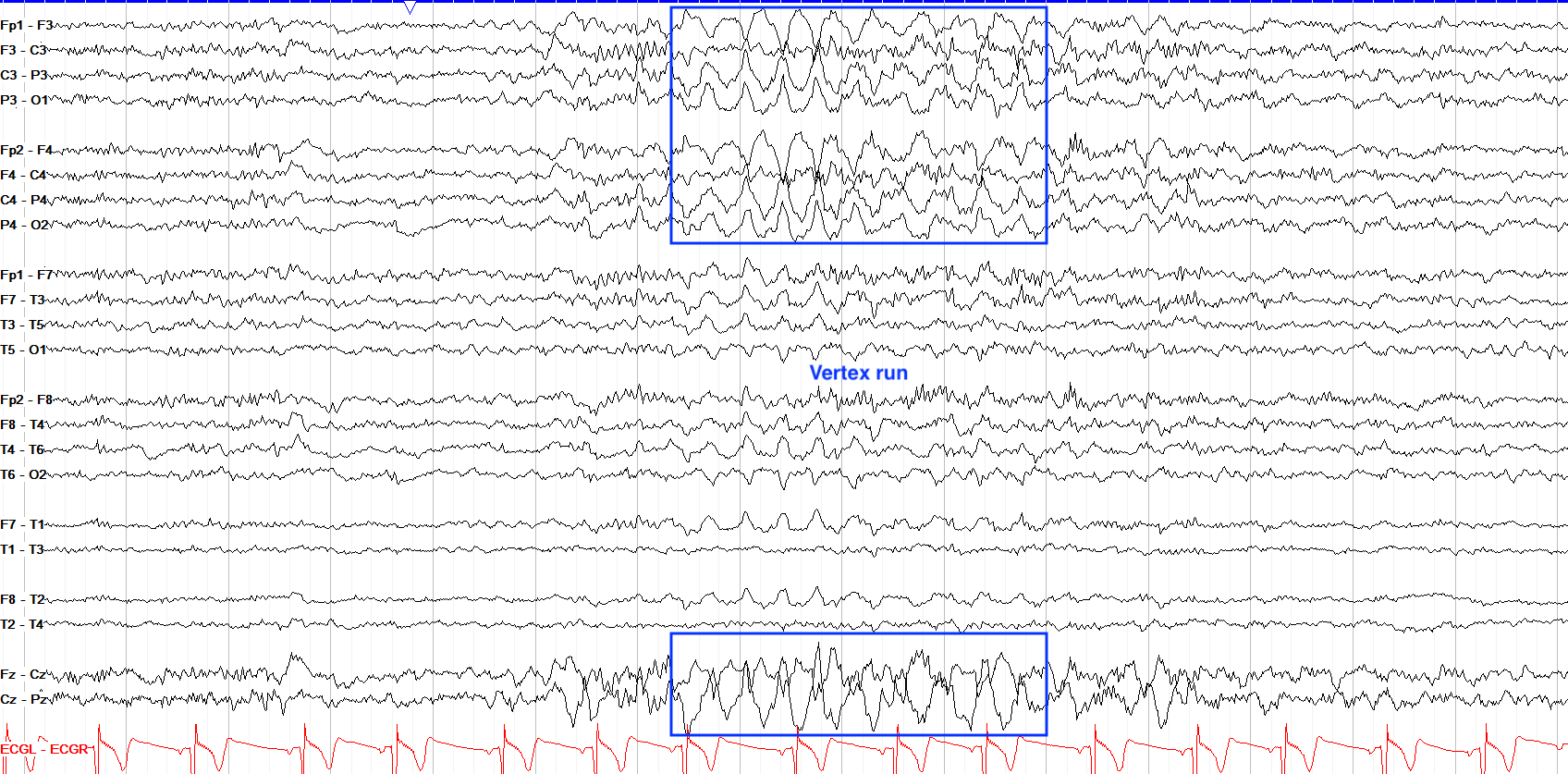 eeg 2009年 Theta waves in children's waking electroencephalogram